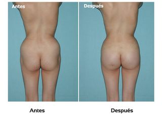 Hilos tensores glúteos