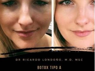 Botox Tipo A