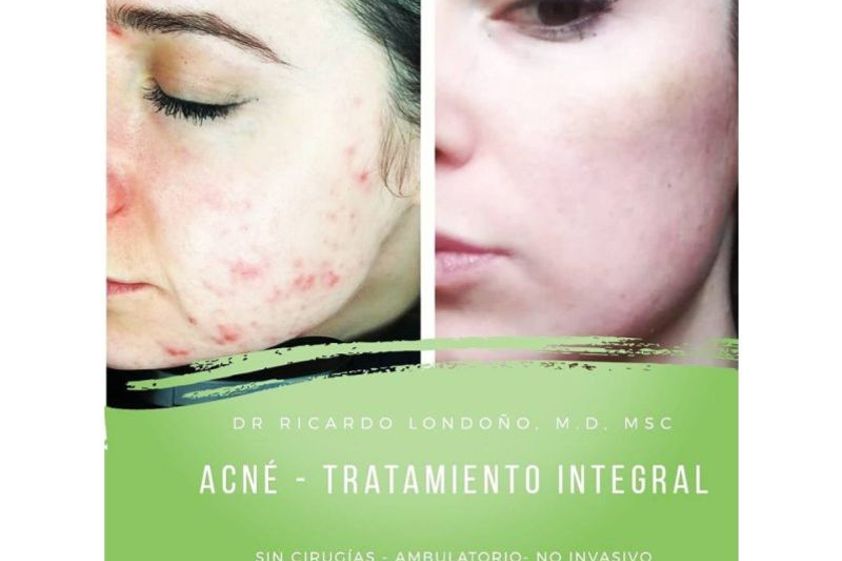 Acné antes y después - 642501