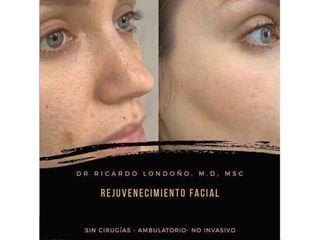 Rejuvenecimiento facial