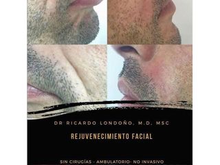 Rejuvenecimiento facial