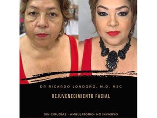 Rejuvenecimiento facial