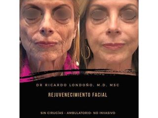 Rejuvenecimiento facial