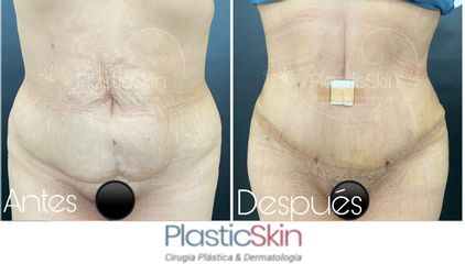 Abdominoplastia - Dr. Ricardo Botache