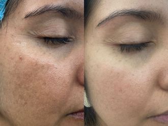 Manchas en la piel antes y después - 877376