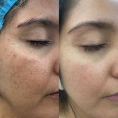 Tratamiento para melasma - Dra. Ketty Romero