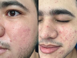 Acné antes y después - 877377
