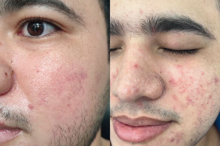 Acné antes y después - 877377