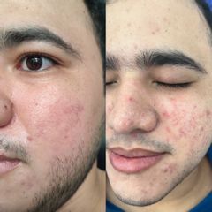 Tratamiento de acné con Láser CO2 - Dra. Ketty Romero