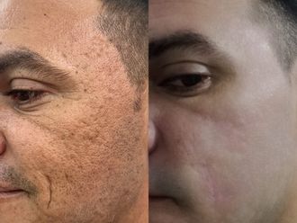 Cicatrices antes y después - 877378
