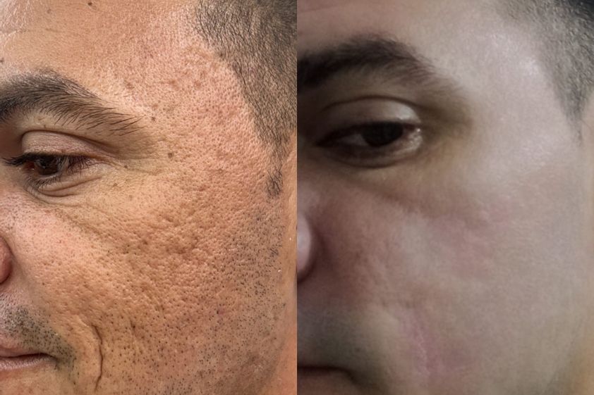 Cicatrices antes y después - 877378
