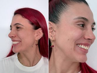 Bótox antes y después - 879182