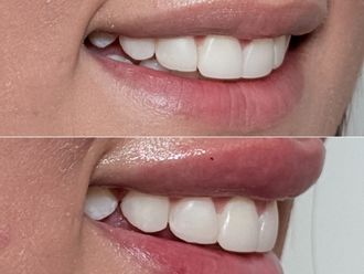 Aumento de labios antes y después - 879183