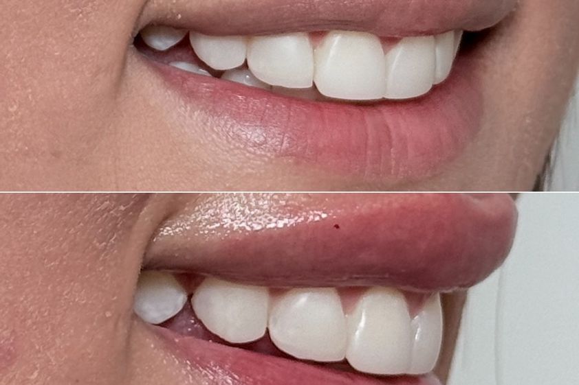Aumento de labios antes y después - 879183