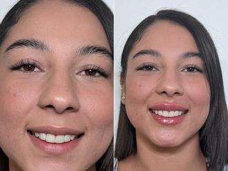 Aumento de labios antes y después - 879184