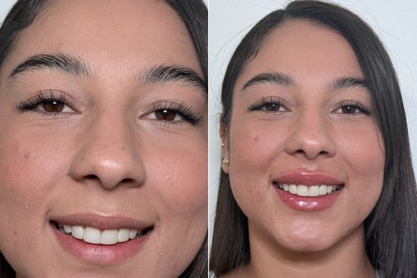 Aumento de labios antes y después - 879184