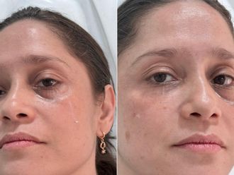 Eliminar ojeras antes y después - 879185