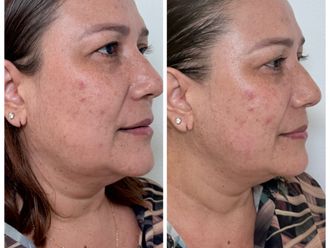 Full Face antes y después - 879294