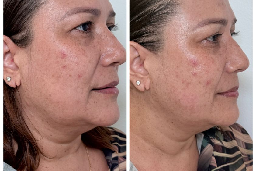 Full Face antes y después - 879294
