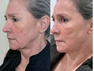 Full Face antes y después - 879296
