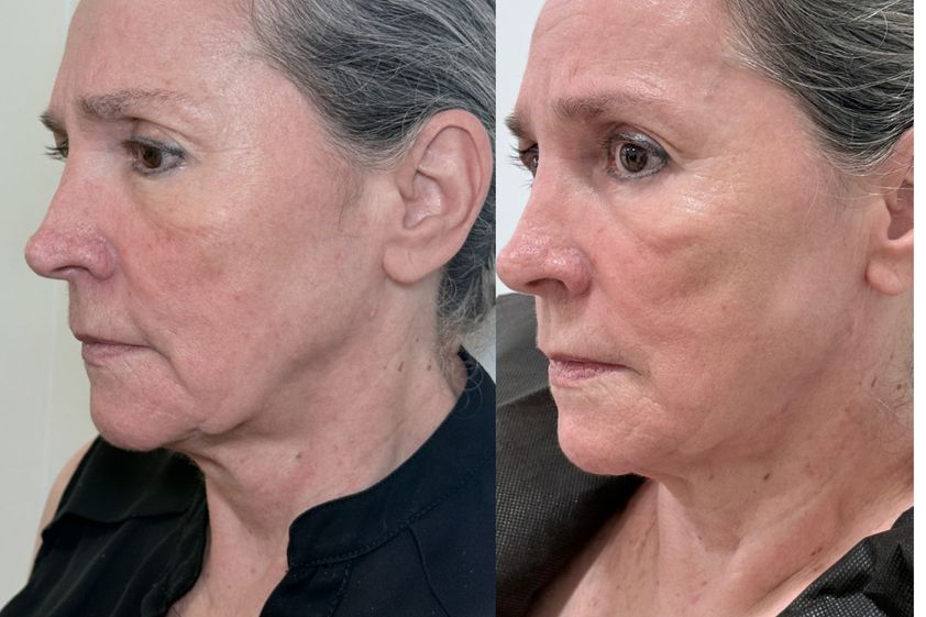 Full Face antes y después - 879296