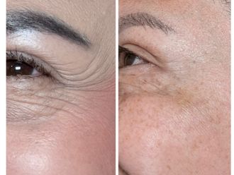 Bótox antes y después - 879912