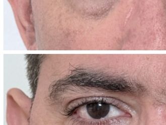 Eliminar ojeras antes y después - 879913