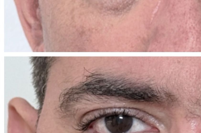 Eliminar ojeras antes y después - 879913