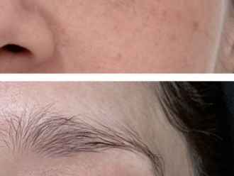 Eliminar ojeras antes y después - 879914