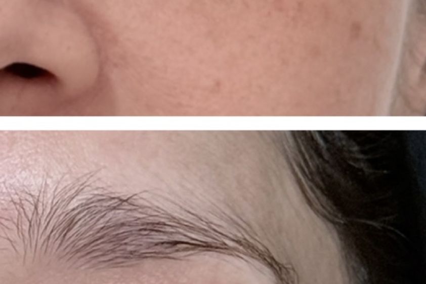 Eliminar ojeras antes y después - 879914