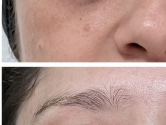 Eliminar ojeras antes y después - 879915