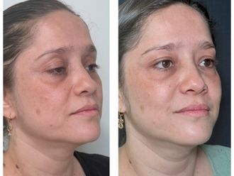 Full Face antes y después - 879916