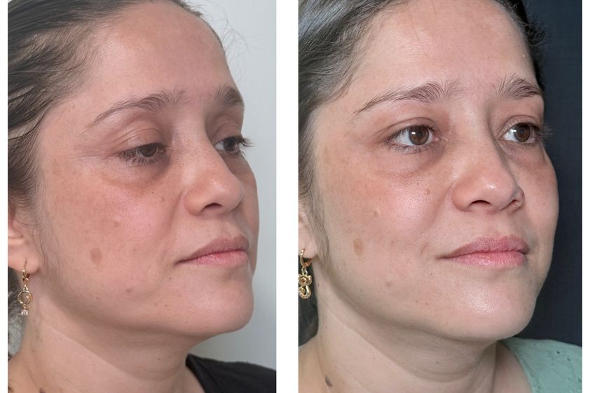 Full Face antes y después - 879916