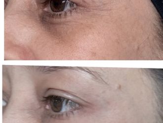 Eliminar ojeras antes y después - 879917