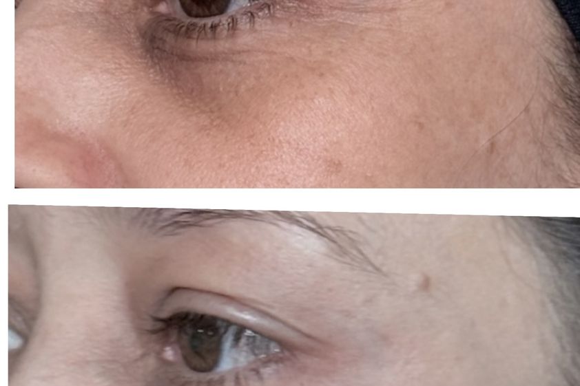 Eliminar ojeras antes y después - 879917