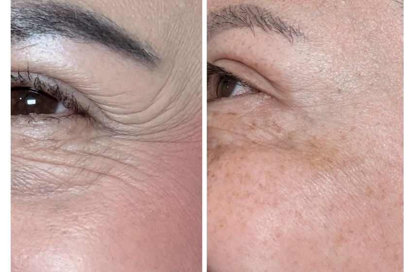 Bótox antes y después - 879918