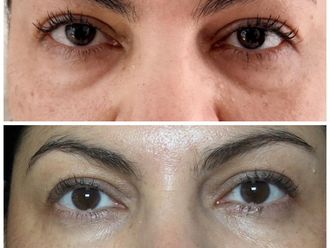 Eliminar ojeras antes y después - 880715