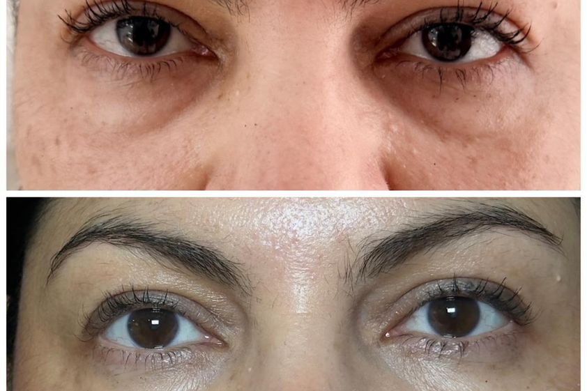Eliminar ojeras antes y después - 880715
