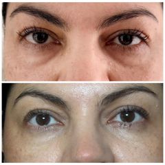 Eliminar ojeras con Sculptra - Dra. Olga Gomez Montoya
