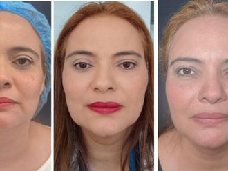 Hilos tensores antes y después - 881174
