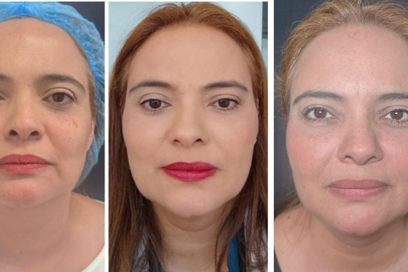 Hilos tensores antes y después - 881174