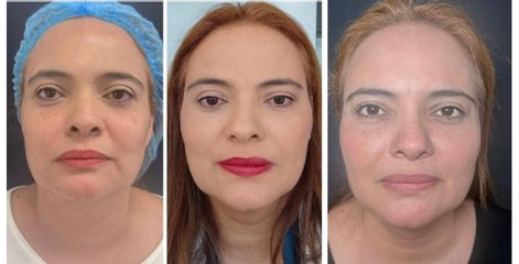 Lifting y Jowls - Dra. Olga Gomez Montoya