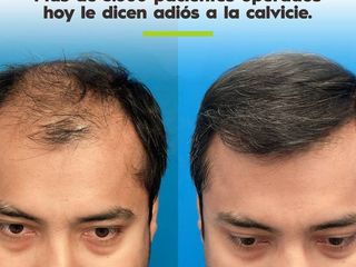 Antes y despues de tratamiento capilar