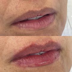 Aumento de labios - Dra. Lucía Arrieta Alvarez