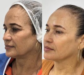 Rejuvenecimiento Facial - Dra. Lucía Arrieta Alvarez