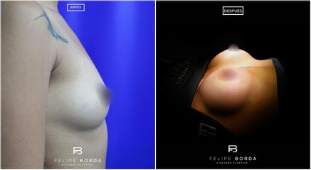 Mamoplastia de aumento - Dr. Luis Felipe Borda