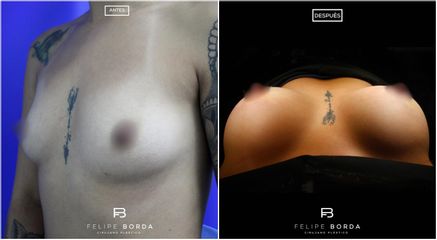 Mamoplastia de aumento - Dr. Luis Felipe Borda