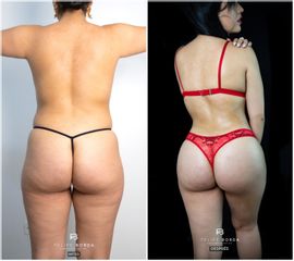 Liposucción - Dr. Luis Felipe Borda