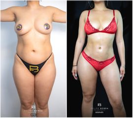 Lipoescultura 360 + Inyección glútea - Dr. Luis Felipe Borda