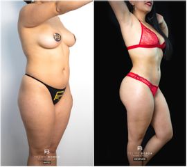 Liposucción - Dr. Luis Felipe Borda